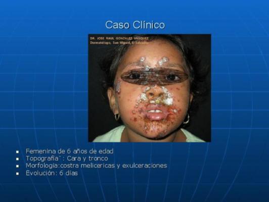 Caso Clínico de Impetigo