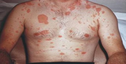 Pitiriasis Rosada