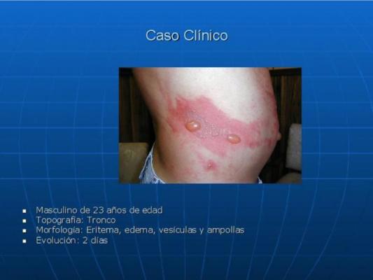 Caso Clínico de Fototoxicidad