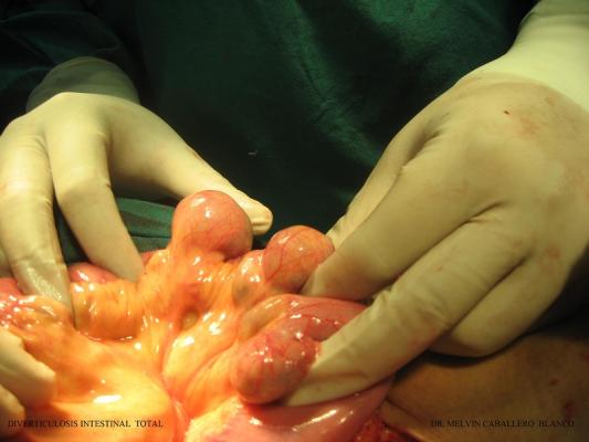 Diverticulosis Intestinal Total