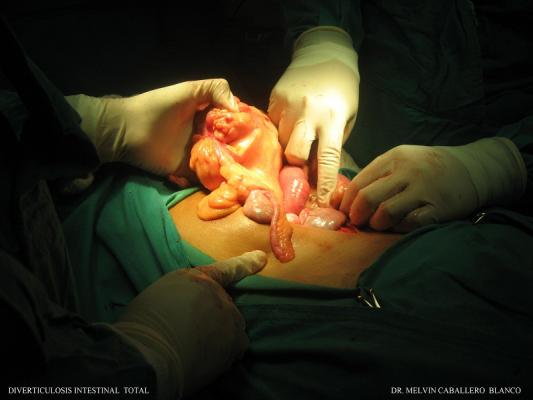 Diverticulosis Intestinal Total
