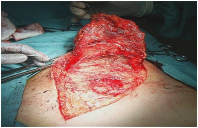 Cáncer de mama, guía de manejo para ginecólogo no oncólogo