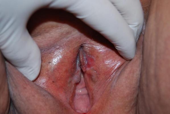 Neo-formación  vulvar pre-maligna. Reporte de caso