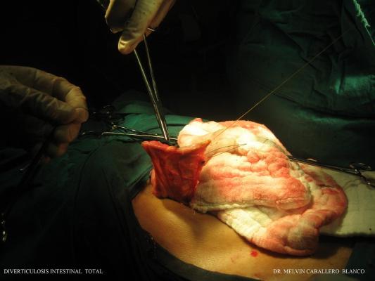 Diverticulosis Intestinal Total
